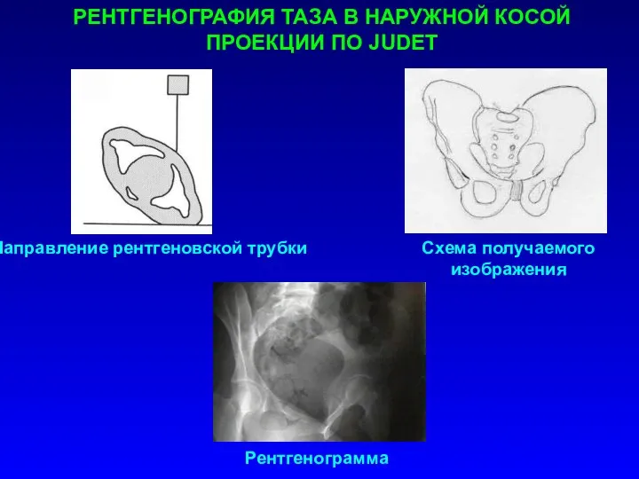 Направление рентгеновской трубки Схема получаемого изображения Рентгенограмма РЕНТГЕНОГРАФИЯ ТАЗА В НАРУЖНОЙ КОСОЙ ПРОЕКЦИИ ПО JUDET