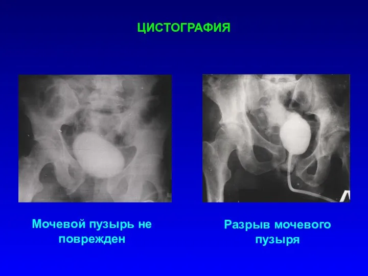 Мочевой пузырь не поврежден Разрыв мочевого пузыря ЦИСТОГРАФИЯ