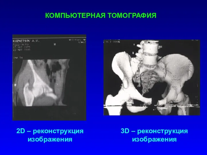 КОМПЬЮТЕРНАЯ ТОМОГРАФИЯ 2D – реконструкция изображения 3D – реконструкция изображения