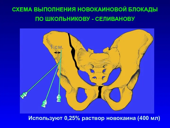 СХЕМА ВЫПОЛНЕНИЯ НОВОКАИНОВОЙ БЛОКАДЫ ПО ШКОЛЬНИКОВУ - СЕЛИВАНОВУ