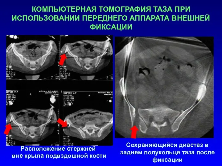 КОМПЬЮТЕРНАЯ ТОМОГРАФИЯ ТАЗА ПРИ ИСПОЛЬЗОВАНИИ ПЕРЕДНЕГО АППАРАТА ВНЕШНЕЙ ФИКСАЦИИ