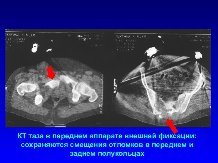 КТ таза в переднем аппарате внешней фиксации: сохраняются смещения отломков в переднем и заднем полукольцах