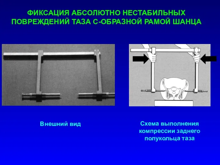 Внешний вид Схема выполнения компрессии заднего полукольца таза ФИКСАЦИЯ АБСОЛЮТНО НЕСТАБИЛЬНЫХ ПОВРЕЖДЕНИЙ ТАЗА С-ОБРАЗНОЙ РАМОЙ ШАНЦА