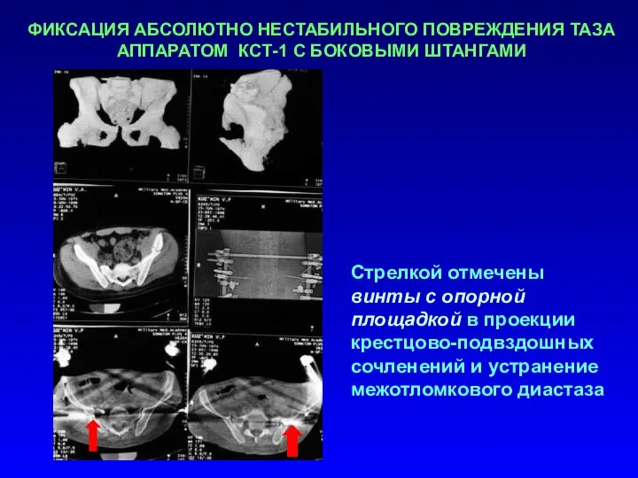 ФИКСАЦИЯ АБСОЛЮТНО НЕСТАБИЛЬНОГО ПОВРЕЖДЕНИЯ ТАЗА АППАРАТОМ КСТ-1 С БОКОВЫМИ ШТАНГАМИ