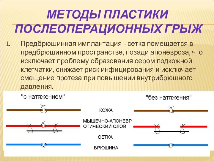 МЕТОДЫ ПЛАСТИКИ ПОСЛЕОПЕРАЦИОННЫХ ГРЫЖ 1. Предбрюшинная имплантация - сетка помещается в