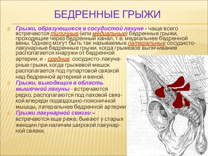 БЕДРЕННЫЕ ГРЫЖИ Грыжи, образующиеся в сосудистой лакуне - чаще всего встречаются