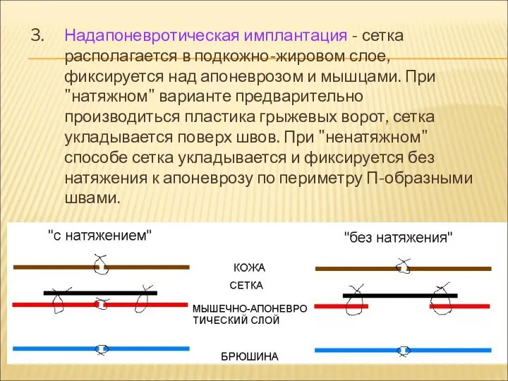 3. Надапоневротическая имплантация - сетка располагается в подкожно-жировом слое, фиксируется над