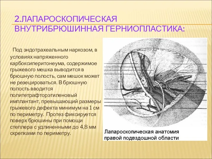 2.ЛАПАРОСКОПИЧЕСКАЯ ВНУТРИБРЮШИННАЯ ГЕРНИОПЛАСТИКА: Под эндотрахеальным наркозом, в условиях напряженного карбоксиперитонеума, содержимое