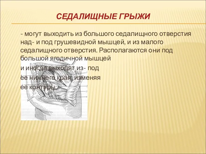 СЕДАЛИЩНЫЕ ГРЫЖИ - могут выходить из большого седалищного отверстия над- и