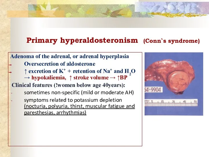 Primary hypеraldosteronism (Conn`s syndrome) Adenoma of the adrenal, or adrenal hyperplasia