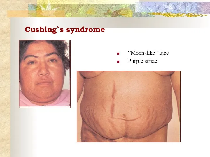 Cushing`s syndrome “Moon-like” face Purple striae