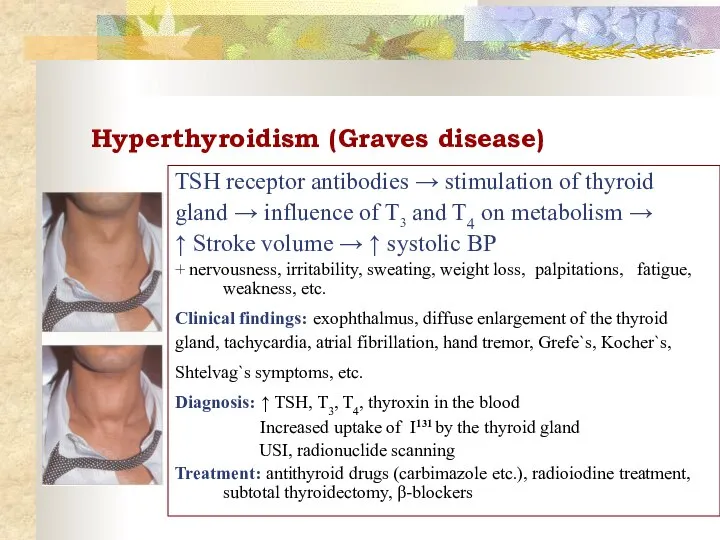 Hyperthyroidism (Graves disease) TSH receptor antibodies → stimulation of thyroid gland