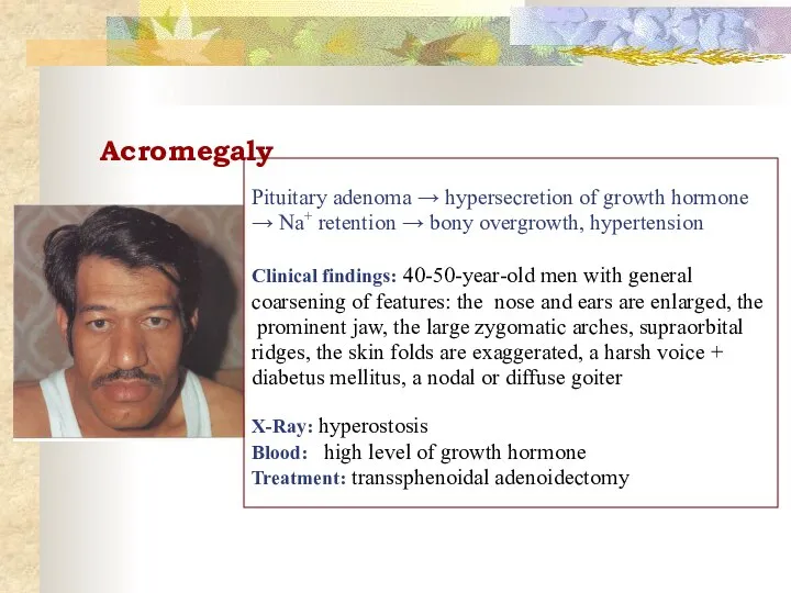 Acromegaly Pituitary adenoma → hypersecretion of growth hormone → Na+ retention