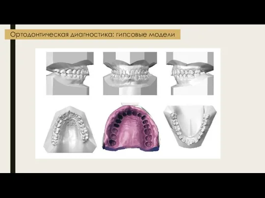 Ортодонтическая диагностика: гипсовые модели