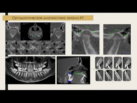 Ортодонтическая диагностика: анализ КТ