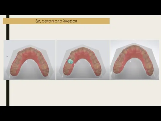 3Д сетап элайнеров