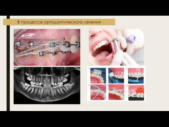 В процессе ортодонтического лечения