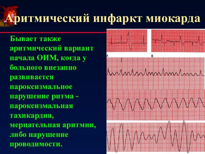 Аритмический инфаркт миокарда Бывает также аритмический вариант начала ОИМ, когда у