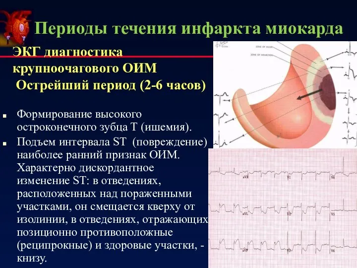 Периоды течения инфаркта миокарда ЭКГ диагностика крупноочагового ОИМ Острейший период (2-6