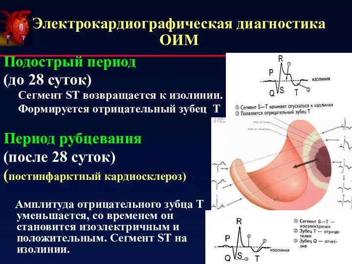 Электрокардиографическая диагностика ОИМ Подострый период (до 28 суток) Сегмент ST возвращается