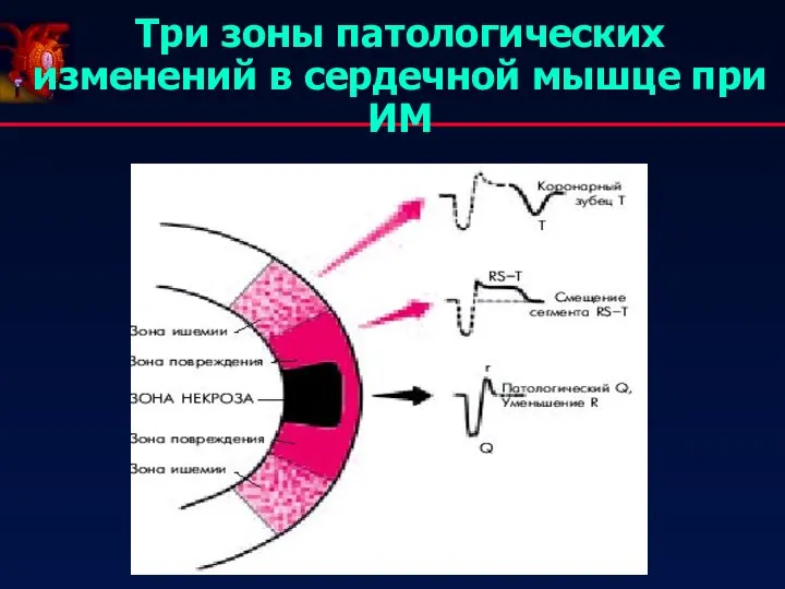 Три зоны патологических изменений в сердечной мышце при ИМ