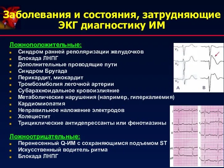 Заболевания и состояния, затрудняющие ЭКГ диагностику ИМ Ложноположительные: Синдром ранней реполяризации