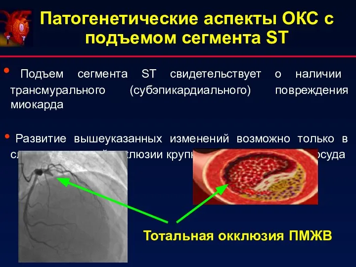 Патогенетические аспекты ОКС с подъемом сегмента ST Подъем сегмента ST свидетельствует