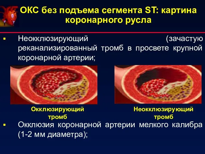 ОКС без подъема сегмента ST: картина коронарного русла Неокклюзирующий (зачастую реканализированный