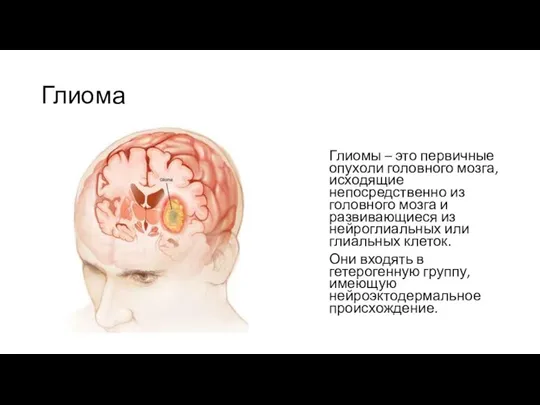 Глиома Глиомы – это первичные опухоли головного мозга, исходящие непосредственно из