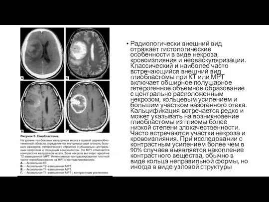 Радиологически внешний вид отражает гистологические особенности в виде некроза, кровоизлияния и