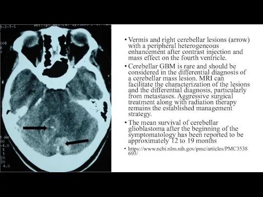 Vermis and right cerebellar lesions (arrow) with a peripheral heterogeneous enhancement