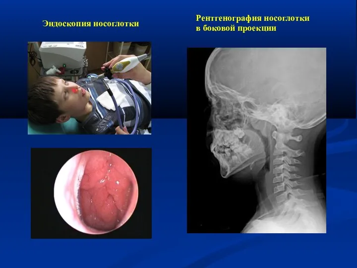 Эндоскопия носоглотки Рентгенография носоглотки в боковой проекции