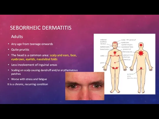 SEBORRHEIC DERMATITIS Adults Any age from teenage onwards Quite pruritic The