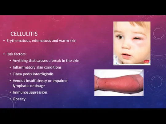 CELLULITIS Erythematous, edematous and warm skin Risk factors: Anything that causes