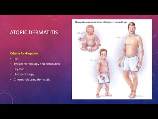 ATOPIC DERMATITIS Criteria for diagnosis Itch Typical morphology and distribution Dry