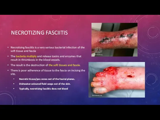 NECROTIZING FASCIITIS Necrotising fasciitis is a very serious bacterial infection of