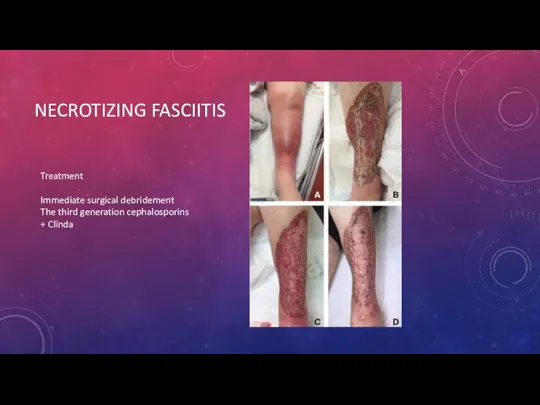 NECROTIZING FASCIITIS Treatment Immediate surgical debridement The third generation cephalosporins + Clinda