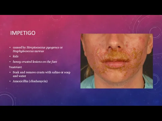 IMPETIGO caused by Streptococcus pyogenes or Staphylococcus aureus kids honey crusted