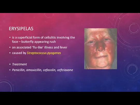 ERYSIPELAS is a superficial form of cellulitis involving the face –