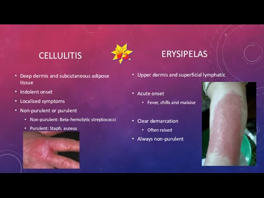 CELLULITIS Deep dermis and subcutaneous adipose tissue Indolent onset Localised symptoms