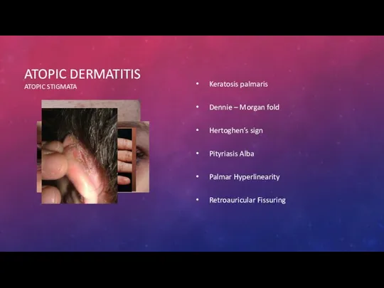 ATOPIC DERMATITIS ATOPIC STIGMATA Keratosis palmaris Dennie – Morgan fold Hertoghen’s