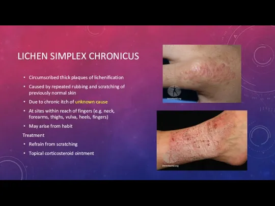 LICHEN SIMPLEX CHRONICUS Circumscribed thick plaques of lichenification Caused by repeated