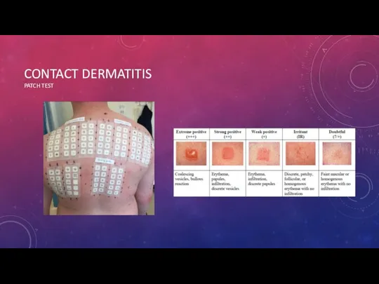 CONTACT DERMATITIS PATCH TEST