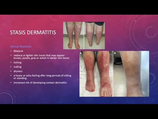 STASIS DERMATITIS clinical features: Bilateral redness in lighter skin tones that