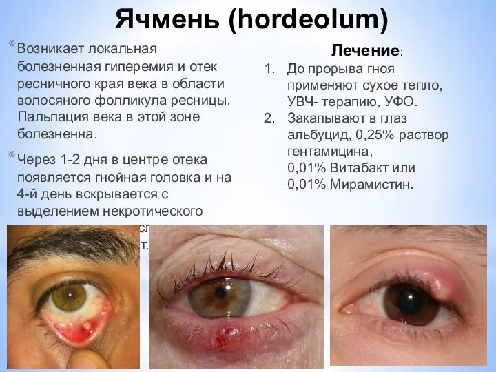 Ячмень (hordeolum) Возникает локальная болезненная гиперемия и отек ресничного края века