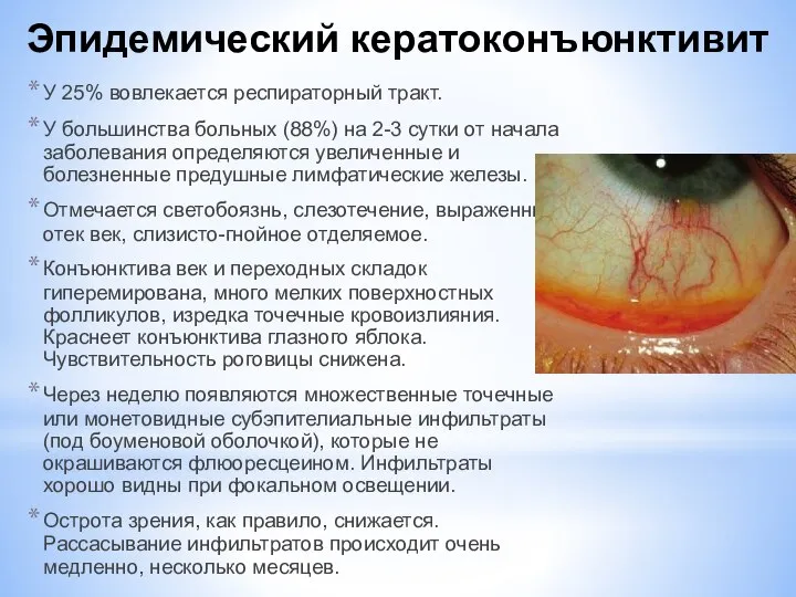 Эпидемический кератоконъюнктивит У 25% вовлекается респираторный тракт. У большинства больных (88%)