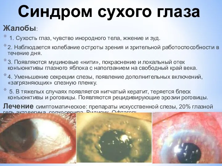 Синдром сухого глаза Жалобы: 1. Сухость глаз, чувство инородного тела, жжение