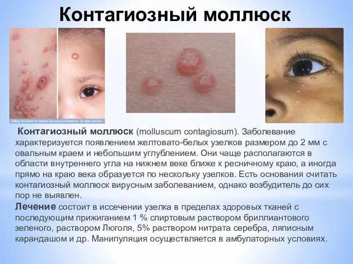 Контагиозный моллюск (molluscum contagiosum). Заболевание характеризуется появлением желтовато-белых узелков размером до