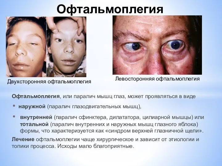 Офтальмоплегия, или паралич мышц глаз, может проявляться в виде наружной (паралич
