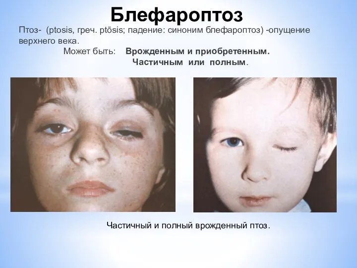 Частичный и полный врожденный птоз. Птоз- (ptosis, греч. ptōsis; падение: синоним